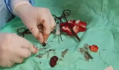 خروج گلوله پس از ۳۸ سال از بدن جانباز