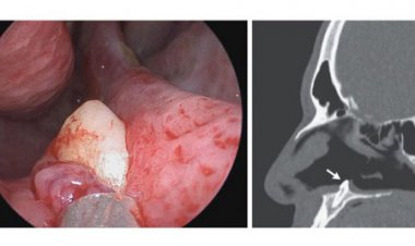 دندان سرکش، سر از دماغ مرد 38 ساله درآورد!