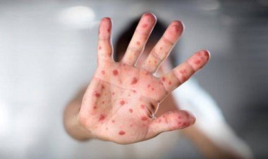 بازگشت مسری‌ترین ویروس عفونی به ایران