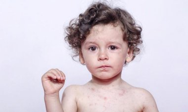 آغاز تزریق واکسن سرخک در بهبهان