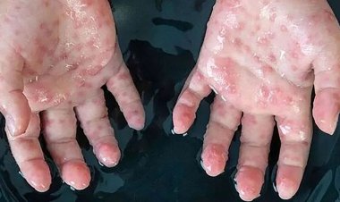 آبله میمون به امارات رسید