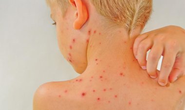 ماجرای مورد مشکوک به آبله میمون در ایران چه بود؟