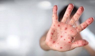 تست ۵ نفر از ۹ مورد مشکوک به آبله میمونی منفی شد