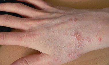 شیوع بیماری پوستی گال در دهستان نصار اروندکنار آبادان