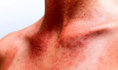 اگر عرق سوز شدیم چه کنیم؟