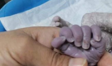تولد نوزادی با ۲۴ انگشت در بغداد