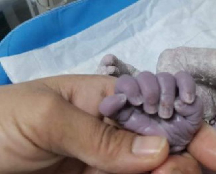 تولد نوزادی با ۲۴ انگشت در بغداد