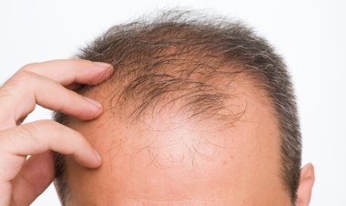 روشی که امیدها را برای درمان طاسی زنده کرده است