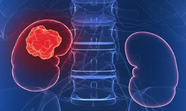 اولین نشانه سرطان کلیه چیست؟    