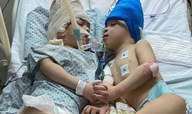 دوقلو‌های برزیلی در عملی ۳۳ ساعته از هم جدا شدند