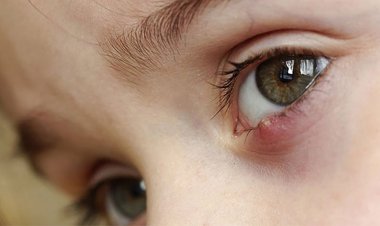 دلیل بروز گل مژه چیست؟