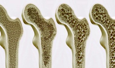 همه زنان ایرانی پوکی استخوان دارند؛ مگر خلافش ثابت شود!