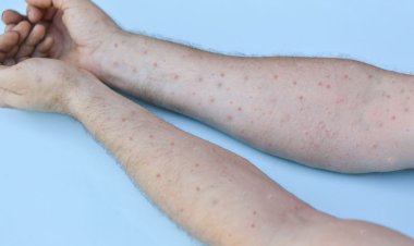 آنفلوانزای گوجه فرنگی  چقدر ترسناک است؟  