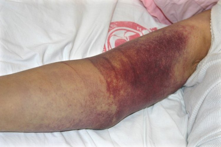 فوت یک بیمار در اثر تب کریمه کنگو در بهبهان