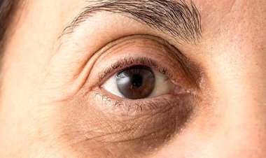 وقتی چشم‌ها خبر از بالابودن کلسترول می‌دهند