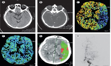 رابطه سکته مغزی زودرس با گروه خونی