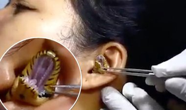 ببینید | لحظه باورنکردنی خارج کردن  مار از گوش دختر جوان