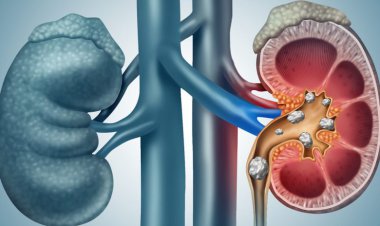 ۱۰ تا ۱۵ درصد ایرانی‌ها سنگ کلیه دارند