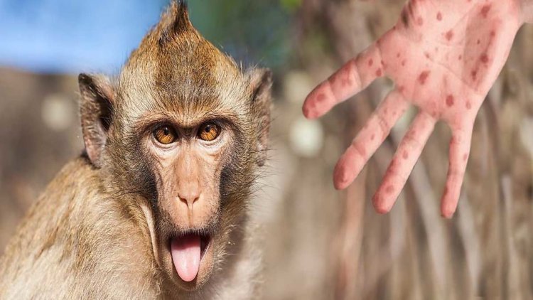 بهبود بیمار مبتلا به آبله‌ میمون در اهواز