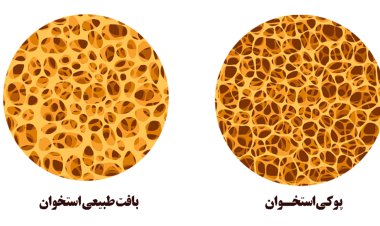 پوکی استخوان، اپیدمی خاموش عصر