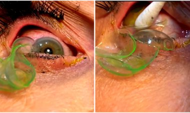 ببینید | لحظه عجیب خارج کردن ۲۳ لنز از چشم یک زن