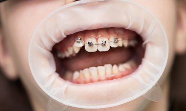 چه زمان به سراغ ارتودنسی برویم؟