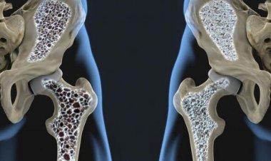 افزایش ابتلا به پوکی استخوان در جهان/ ابتلای دوسوم زنان بالای ۶۰ سال ایران
