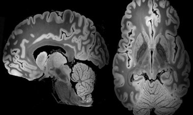 توسعه روشی برای تشخیص تومورهای مغزی بدخیم   