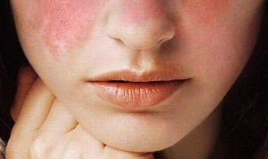 بیماری هزارچهره  که  زنان را شکار می کند