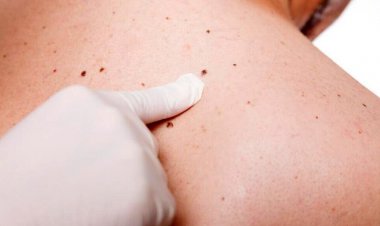 درمان سرطان پوست با یک روش جدید