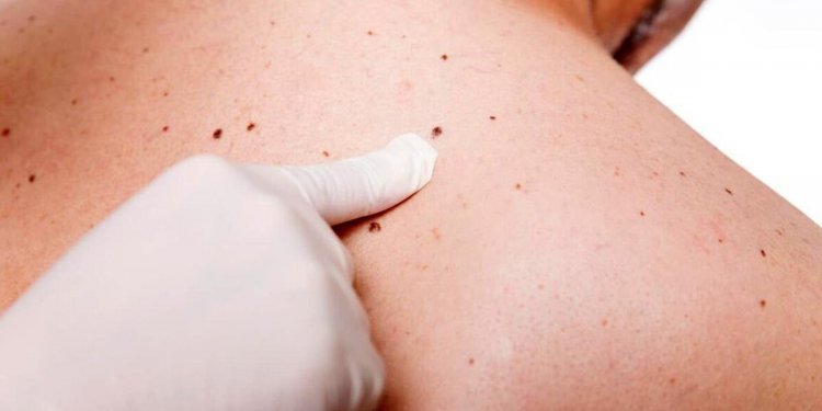 درمان سرطان پوست با یک روش جدید
