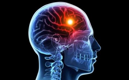 شایع‌ترین عوامل بروز سکته مغزی