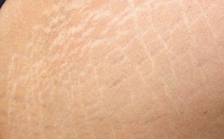 سلولیت چیست و چرا بوجود می‌آید؟