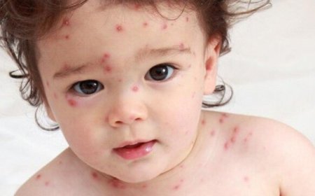 آبله‌مرغان از نگاه طب سنتی