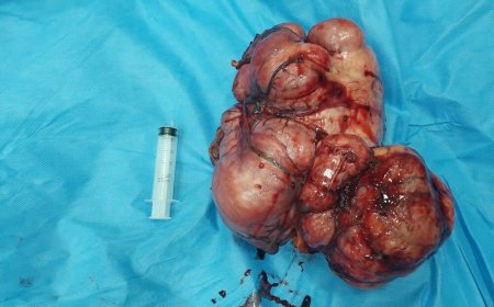 کشف توده ۵ کیلویی در حین عمل زیبایی بیمار جوان + عکس