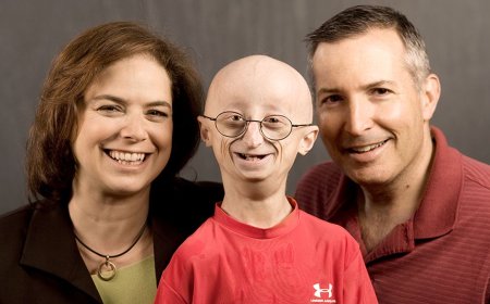 سندروم پروگریا؛ عجیب ترین بیماری جهان