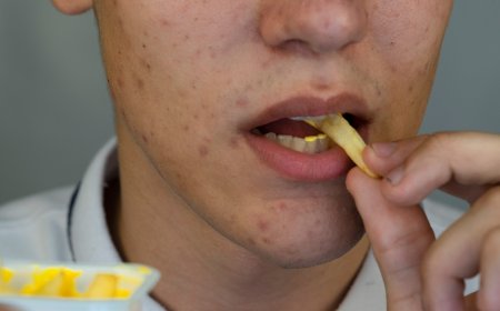 این خوراکیها باعث جوش صورت میشود