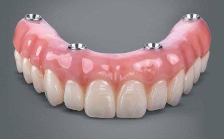 اوردنچر متکی بر ایمپلنت چیست؟